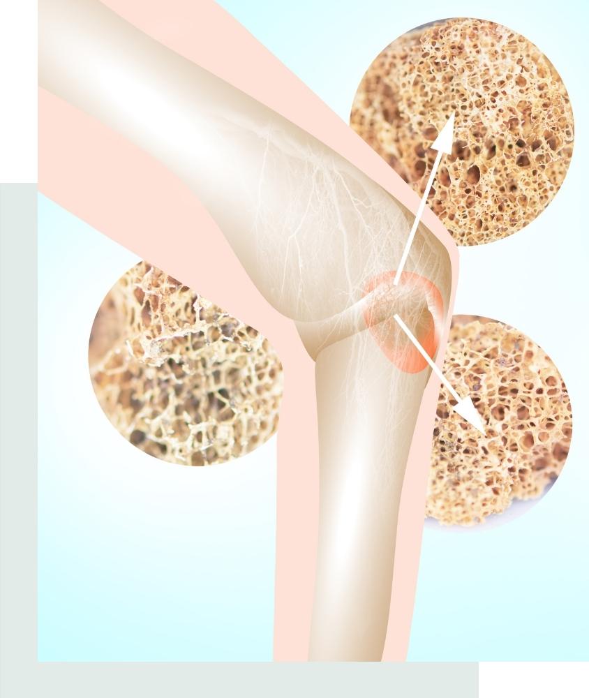 causes of osteoporosis